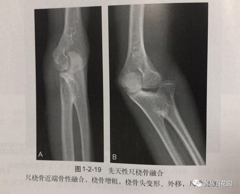 尺橈骨融合最新方法，探索前沿技術(shù)以優(yōu)化治療結(jié)果
