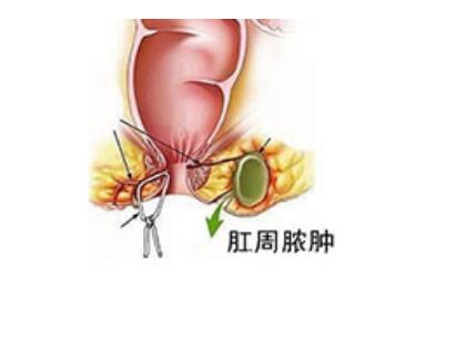 肛周膿腫最新手術(shù)方法，探索與解析